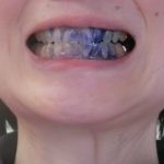 プラーク有り染め出し